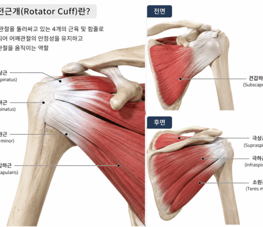 회전근 개 파열 증상 치료를 위한 재활법