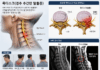 목 디스크 증상 및 일상에서 할 수 있는 운동 예방법