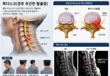 목 디스크 증상 및 일상에서 할 수 있는 운동 예방법